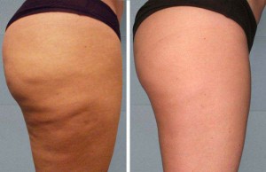 Voici ce que vous devriez boire si vous voulez expulser la graisse du ventre et la cellulite naturellement et rapidement!