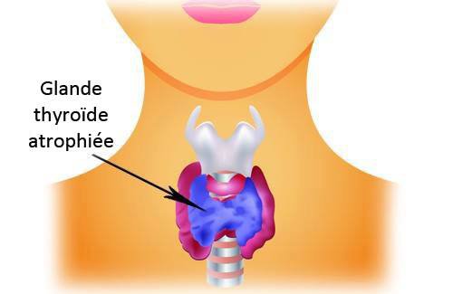 thyroiide