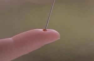 Comment sauver quelqu’un d’un AVC avec juste une aiguille ?