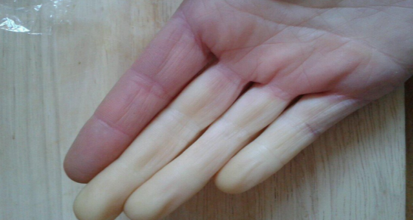 raynaud