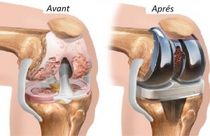 Cette femme s’est débarrassée des douleurs articulaires en un jour et sans aller chez le médecin, Découvrez son remède secret…