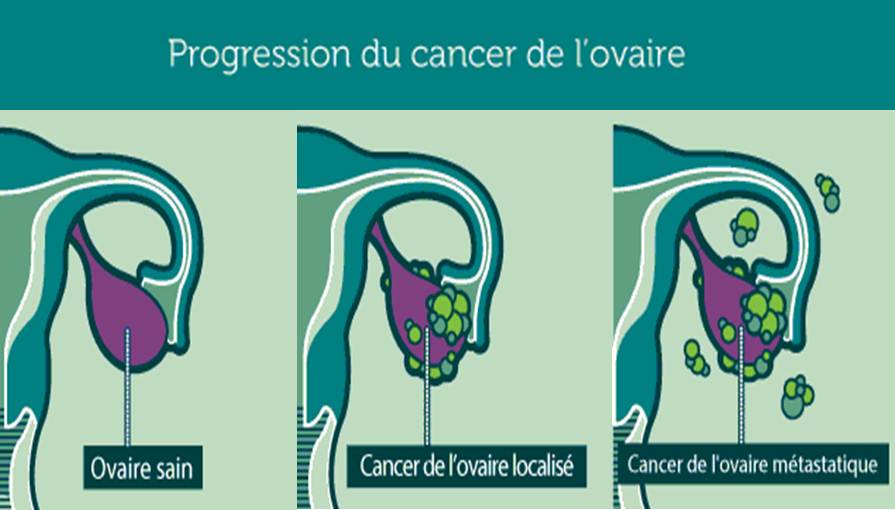 Les signes du cancer des ovaires qui risque de vous tuer — free download