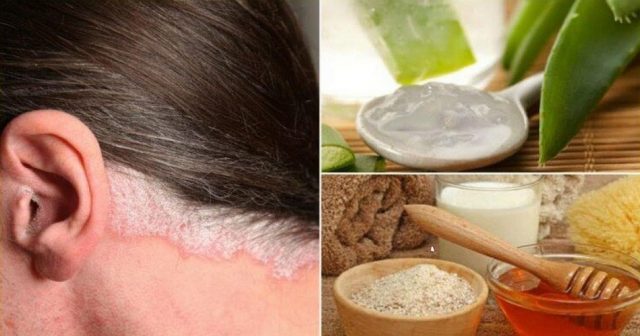 5-remedes-faits-maison-pour-soulager-le-psoriasis-du-cuir-chevelu-NewsMAG