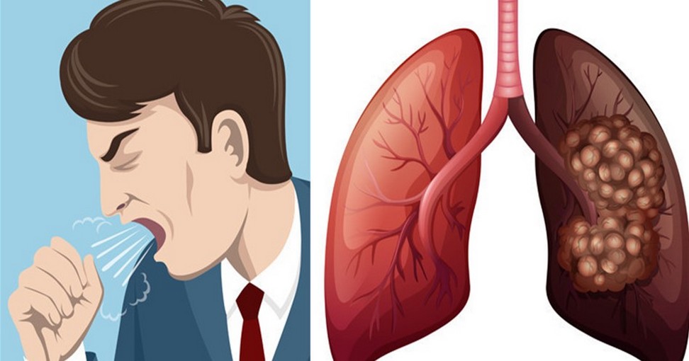 Signes du cancer du poumon que vous devez connaître NewsMAG