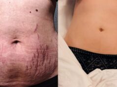 Voici 8 astuces pour retrouver une peau ferme après l’accouchement Voici 8 astuces pour retrouver une peau ferme après l'accouchement