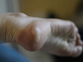 5 astuces simples et rapides pour soigner une ampoule