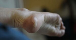 5 astuces simples et rapides pour soigner une ampoule 5 astuces simples et rapides pour soigner une ampoule