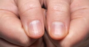 Est-il possible de remédier aux stries sur mes ongles ? Quelles en sont les causes ? Est-il possible de remédier aux stries sur mes ongles ? Quelles en sont les causes ?