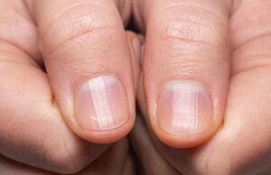 Est-il possible de remédier aux stries sur mes ongles ? Quelles en sont les causes ? Est-il possible de remédier aux stries sur mes ongles ? Quelles en sont les causes ?