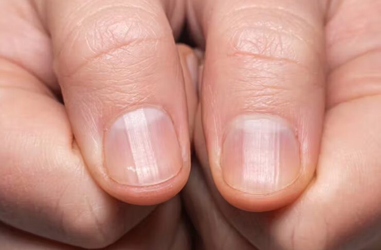 Est-il possible de remédier aux stries sur mes ongles ? Quelles en sont les causes ?