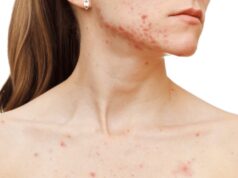 5 conseils efficaces pour éliminer les boutons sur le décolleté 5 conseils efficaces pour éliminer les boutons sur le décolleté