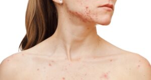 5 conseils efficaces pour éliminer les boutons sur le décolleté 5 conseils efficaces pour éliminer les boutons sur le décolleté