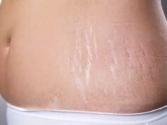 Vergetures : deux soins maison pour les atténuer efficacement Vergetures : deux soins maison pour les atténuer efficacement