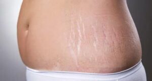 Vergetures : deux soins maison pour les atténuer efficacement Vergetures : deux soins maison pour les atténuer efficacement