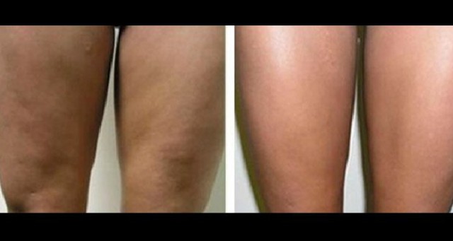 Débarrassez-vous de la cellulite avec ces traitements naturels - NewsMAG